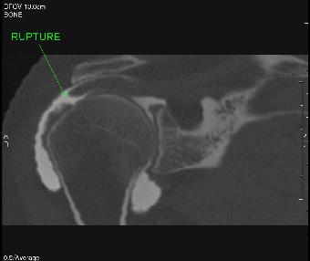 rupture du sus épineux intermédiaire à l'arthroscanner coupe coronale
