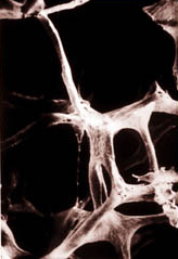 Tendinite calcifiante de la coiffe